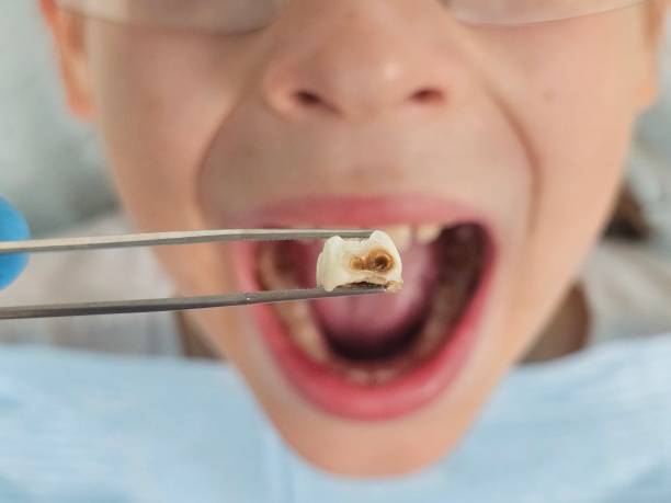 Best Emergency Tooth Extraction in Granite Shoals, TX